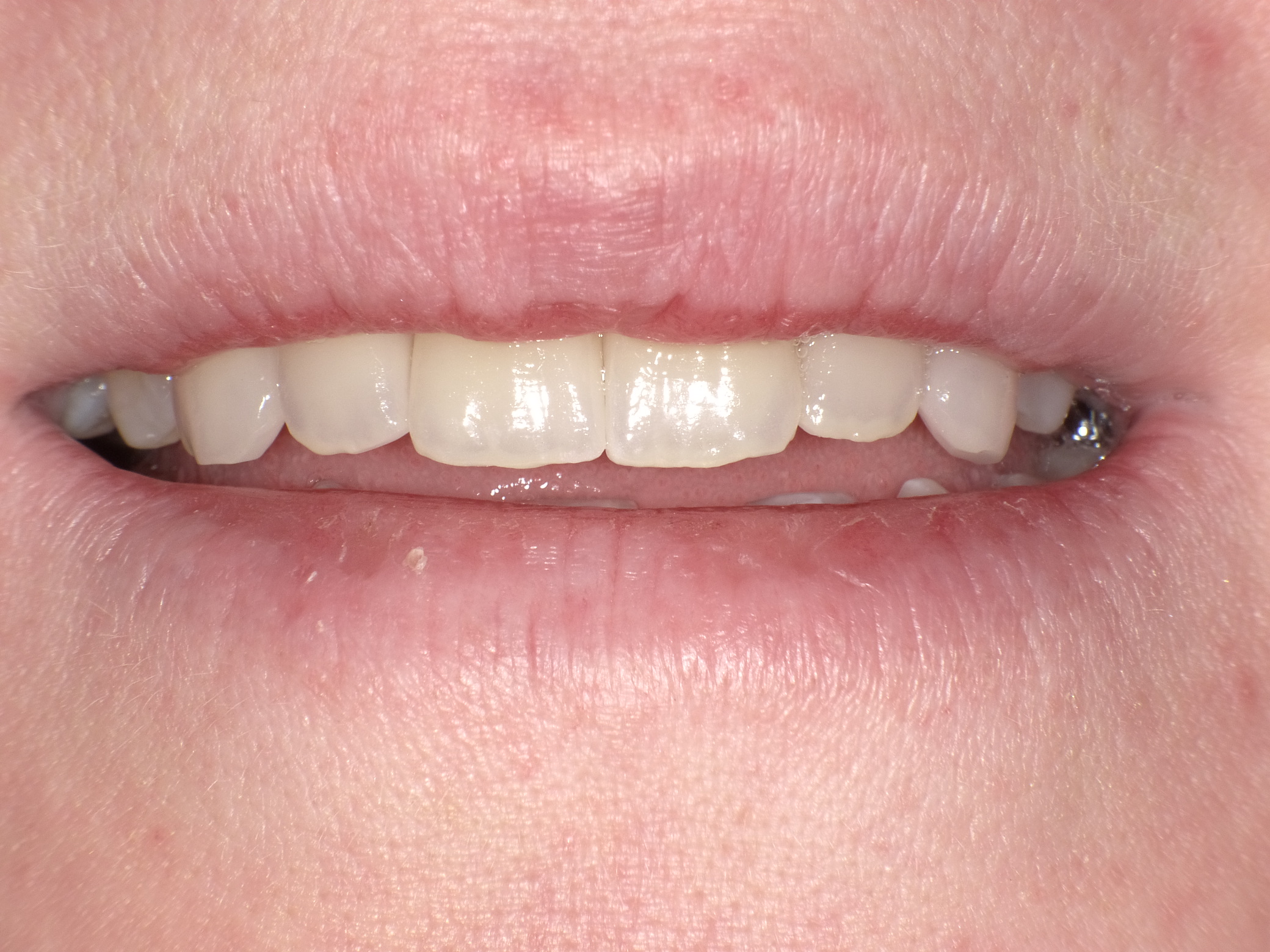 Ästhetische Korrektur mit Veneers aus Vollkeramik